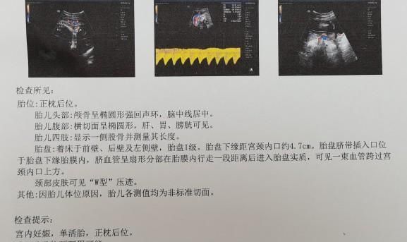 胎盘|年轻孕妈产检只想测胎心,医生建议B超后,竟然又被要求立即住院