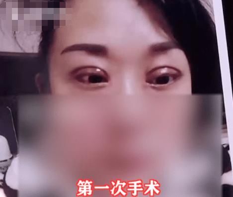 手术|女子花2万元割双眼皮失败，老公看后要闹离婚，女子：大家来评评理