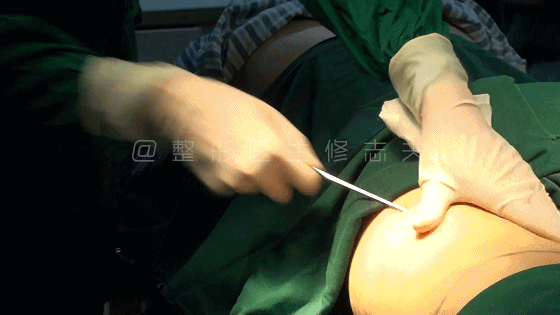 做吸脂术，是什么感受呢？