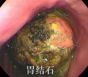 肠坏死|6岁孩子吃柿子导致肠坏死!医生告诉您这样吃柿子能致命!