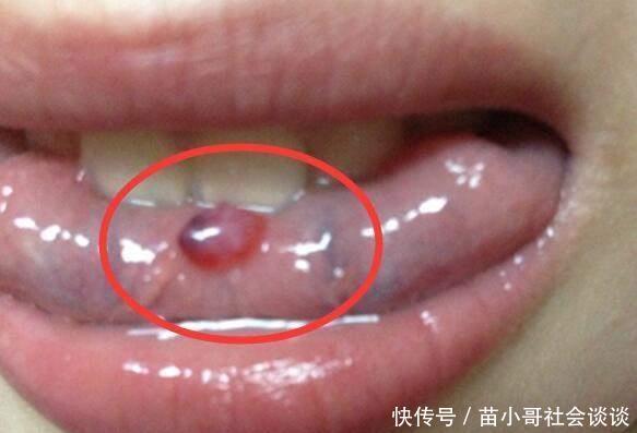 舌头上长出口腔溃疡 不料是舌癌 舌癌早期有哪些症状 快资讯 舌头上长出口腔溃疡 不料是舌癌 舌癌早期有哪些症状 快资讯
