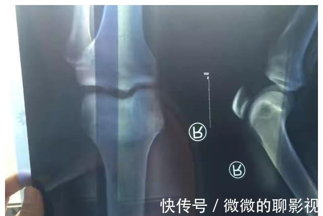 医生|爸爸1.78米妈妈1.62米,高二男孩仅1米6出头,医生一句