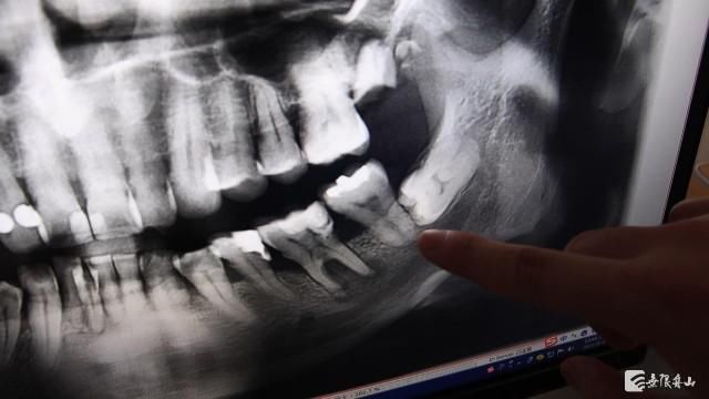 牙齿|只要智齿不疼就不用拔吗？