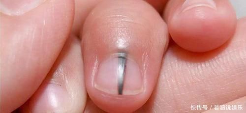 皮肤科|指甲这6个现象,暗示你生病了,要注意,第一个代表患有心脏病