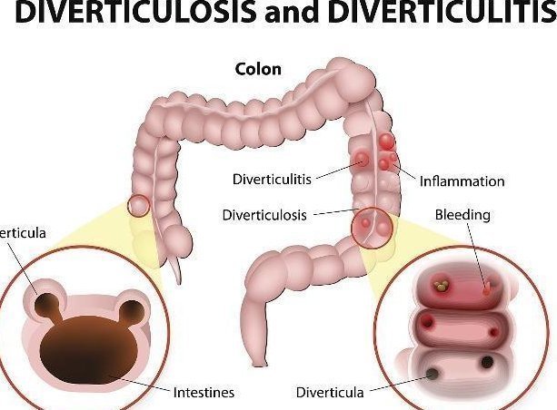 奶制品|为何便秘的人越来越多谨住，易给肠道“添堵”的3大食物需少碰