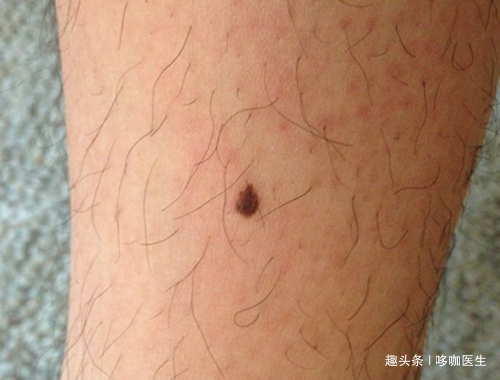 粘膜|60岁大爷抠手患癌，医生提醒手欠会诱发癌症