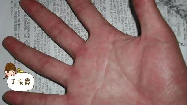 蜘蛛|肝硬化早期要注意!身上长出“这三物”,及时诊察避肝癌