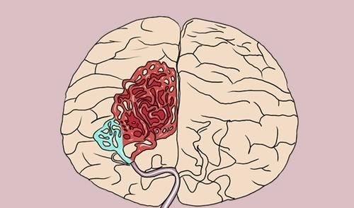 升高|血压多高可能引发脑出血?医生给出参考值,高血压患者需留意