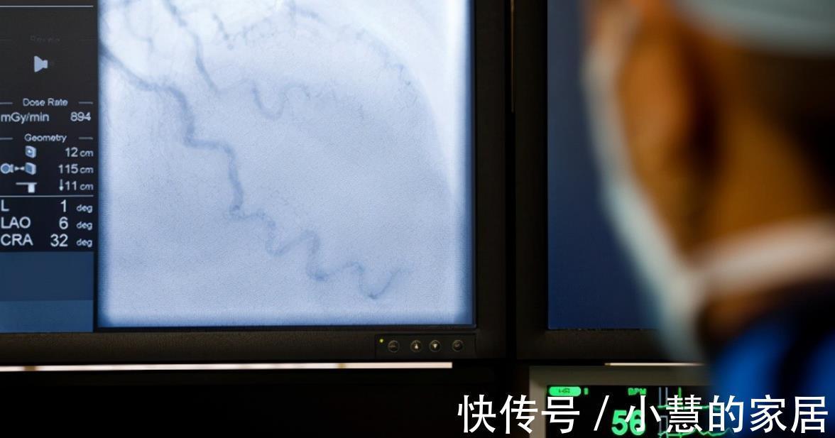冠状动脉造影|8年冠心病没吃药,复查冠脉造影竟然“消失”了!冠心病能自愈?