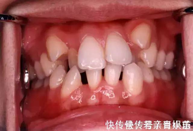 乳牙|家长必读权威专家提醒:必须在12岁前处理的10种儿童牙颌畸形