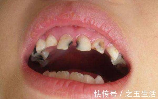 乳牙|让孩子“满嘴烂牙”的不是糖,而是“这1物”,每个人家里都有