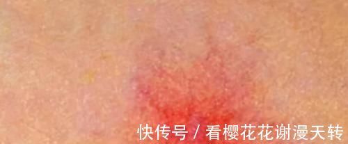 信号|肝硬化前有2个“危险信号”，肝不好及时自查，降低风险