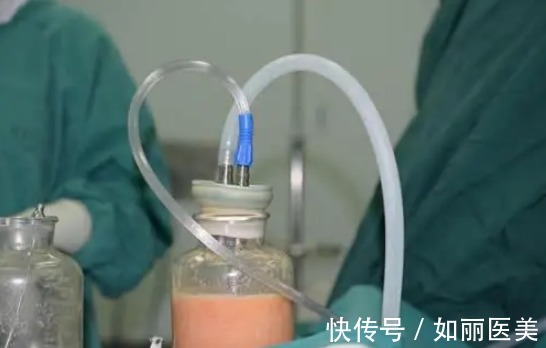 抽脂 吸脂手术疼痛度如何?术后怎样才能快速恢复呢?