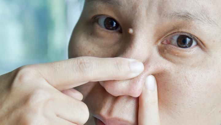 鼻上黑头总长不停是怎回事?6个要点需谨记,还你洁白鼻子