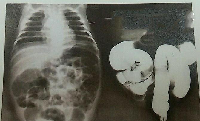 奶量|宝宝出现这6个表现,说明过度喂养了!快停手!