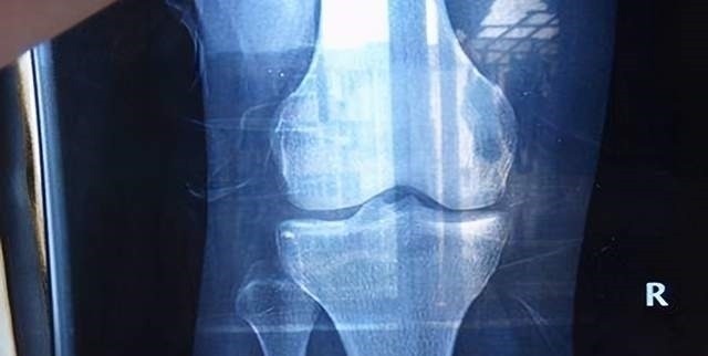 黄金期|家长矮孩子就一定矮吗?抓住三个“猛涨期”,想有个大高个不是梦