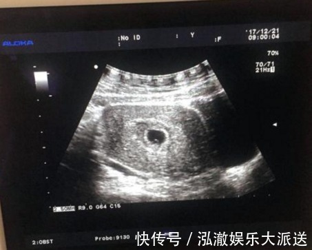 胎儿|怀孕5个月坚持健身,被胎儿“撑破”子宫身亡,丈夫泪目两行