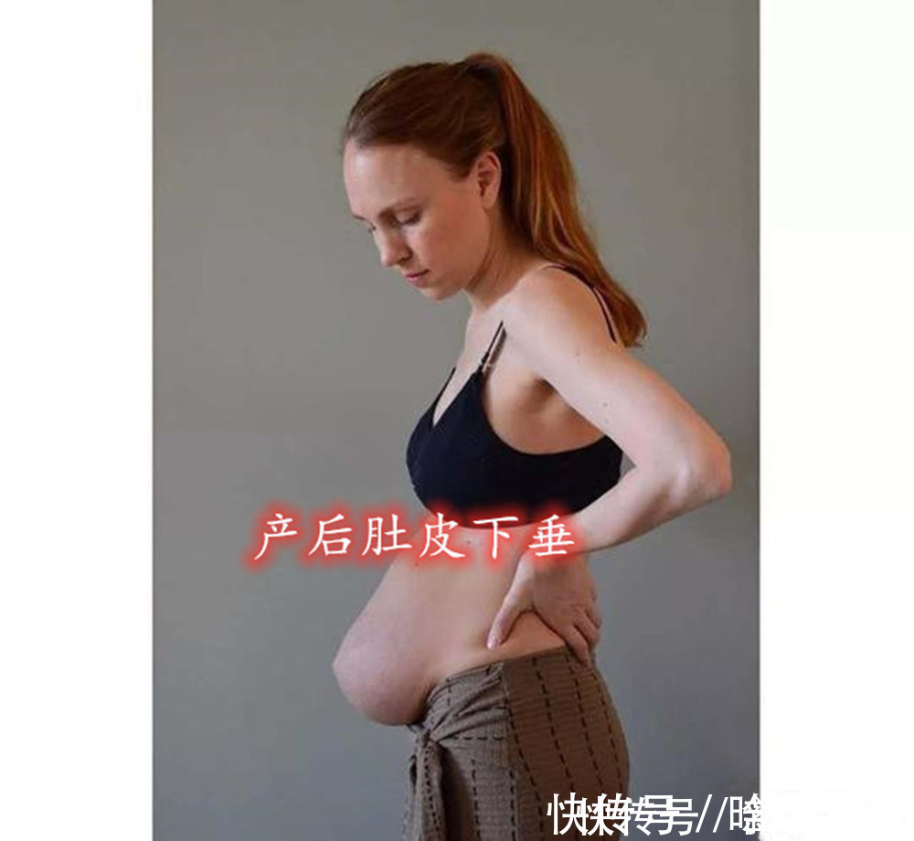 三胞胎|丹麦妈妈怀上三胞胎,产后肚皮却“收不回去”,看完照片感同身受