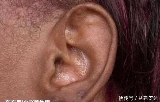 虚劳病|29岁女子,肾衰竭离世,医生解释吃饭时1个习惯害的