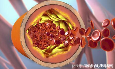 放一物|55岁夫妻酒肉不碰,胆固醇高达10.8,确诊脑梗,医生:炒菜放一物