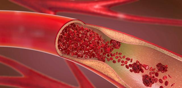 甘油三酯|高血脂不能碰“牛奶”?医生:甘油三酯超标,这2物还需尽早拉黑
