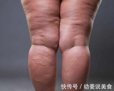 郭姐|老人脚肿腿肿,医生教他一招,不用吃药,4天后浮肿完全消失