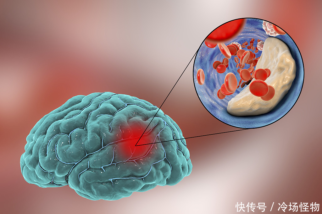  离脑|入冬后，不想脑梗谨记“远离3物，多做3事”，离脑梗远远的