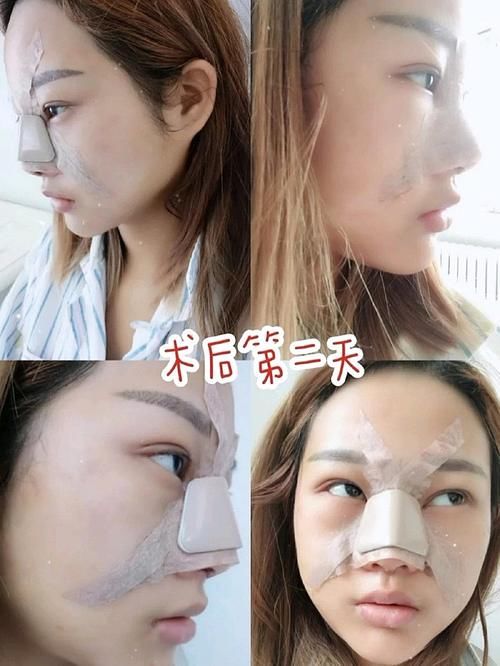 自体软骨垫鼻尖为什么会越来越低？