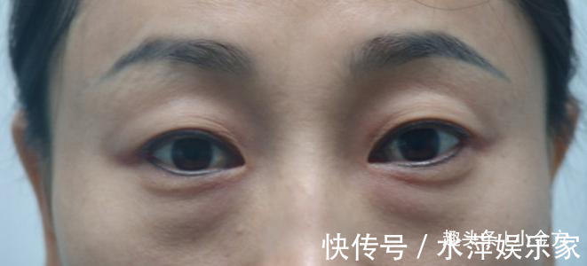 瘀血|人老眼先老,2个护眼妙招,坚持一个月,好处自动找上门!