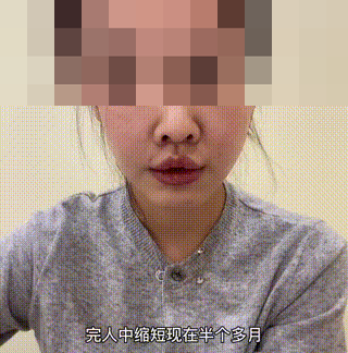 人中 人中长=很显老?“人中缩短手术”可以做吗?