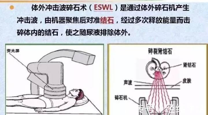 尿路结石|有一种病平时不疼,发作的时候比生孩子还疼,好发于年轻男性