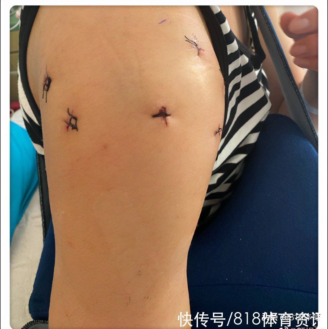 手术|泪目!女排北长城颜妮6个半小时手术报平安,修复右肩成功打8颗钢钉