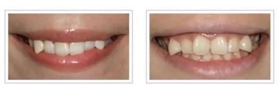 黄金期|孩子牙齿矫正,必须要12岁以后吗?你是否错过了孩子的矫正黄金期