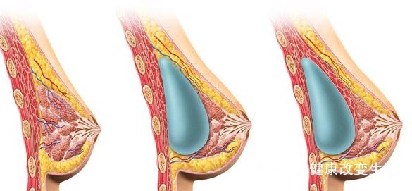 黄花郎地丁茶|乳腺癌开始时,身体有四种迹象,一个不占,你很健康