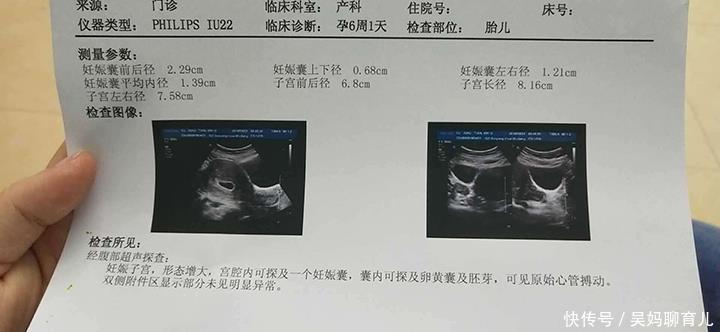怀孕七周胎芽2mm 怀孕七周胎芽2mm