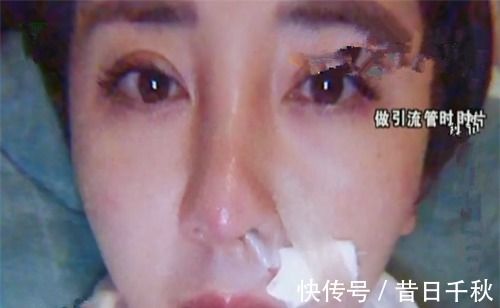 整形|女子整形失败化脓, 整形机构笑着回答 是你个人体质问题!