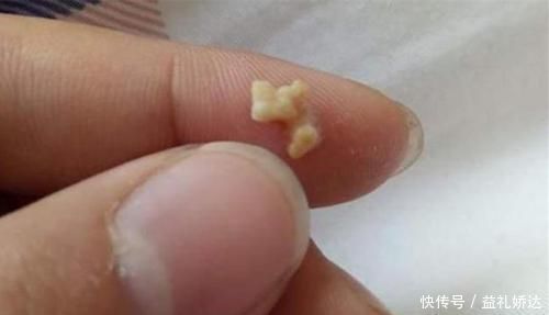 孩子|“你嘴巴好臭”,孩子因嘴臭被欺负,送医检查后取出的颗粒确实臭