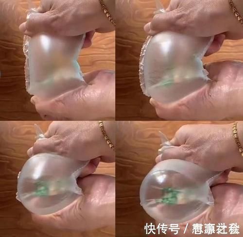 激素|“毁容式”怀孕之妊娠纹:10个孕妈9个长纹,教你咋应对咋预防