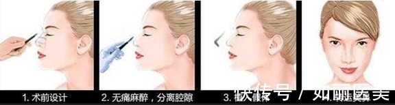 注射隆鼻 隆鼻手术一般多少钱?隆鼻能保持多久?