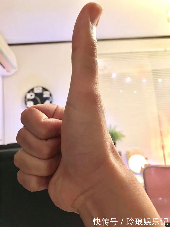 脚趾|19个“被上帝挑选过”的特殊基因人类,怎么梳都不整齐的头发