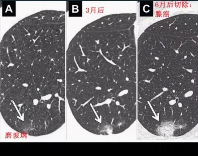 原发灶|两个肺癌病人都拖了2年才治疗，一个治愈，一个扩散了