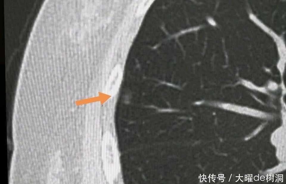 年年体检,为什么还得了晚期肺癌?体检有啥用!