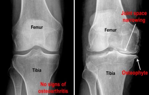越来越|人老了,感觉腿越来越无力,有没有办法对抗呢?有!医生告诉您!