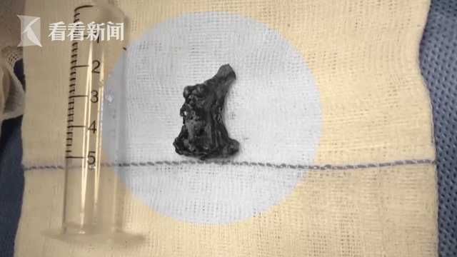 鼻窦炎|老人鼻子突然流“血涕” 元凶竟是一块“石头”