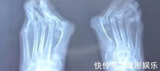 拇指 爱穿高跟鞋的女性一定要小心,拇指外翻堪比“裹脚”!不可忽视