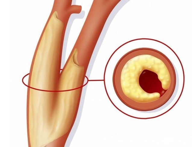 颈动脉斑块|颈动脉出现硬化斑块,必须吃他汀和阿司匹林本文辟谣讲出实情
