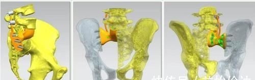 3d打印技术|腿麻胀痛竞查出肿瘤!专家:这些疾病也可引起腿麻胀痛