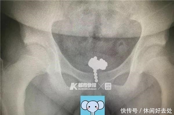 11岁男孩将70颗磁力珠塞尿道，医生呼吁别给孩子买了！