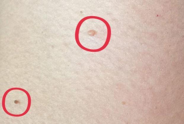 身体|脖子上长出了“小肉粒”是什么也许是身体向你发出的“暗号”