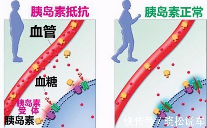 医生|医生直言:患有糖尿病,光降血糖没有用,减少胰岛素抵抗才是关键